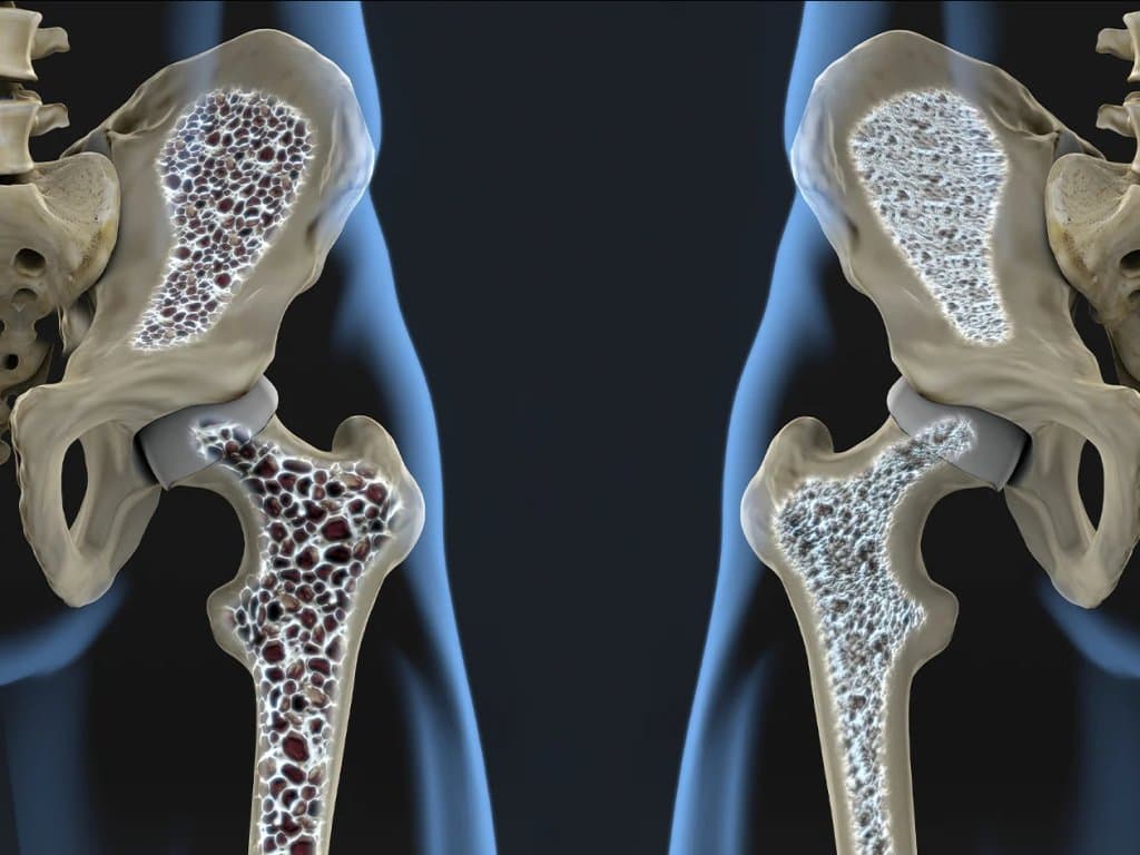 TyG index predicts osteoporosis in type 2 diabetes patients