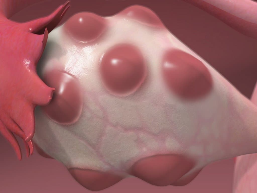 PCOS in Wilson Disease: Hormonal Imbalance and Liver Damage