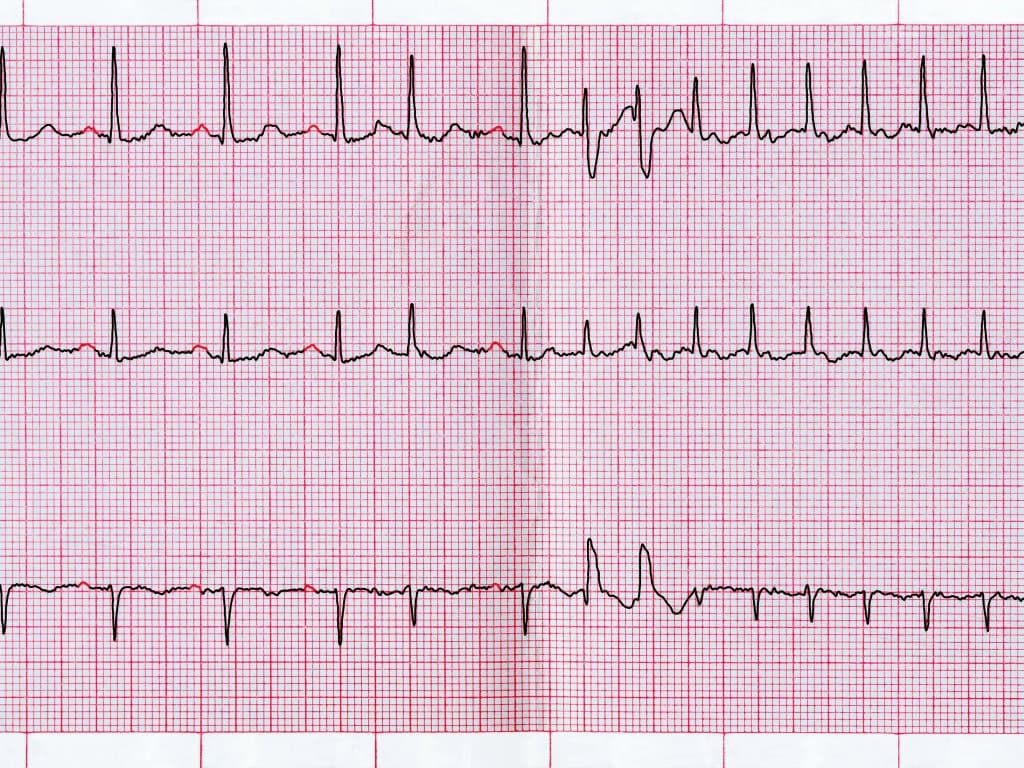 Prognostic value of the TyG index in critically ill AF patients