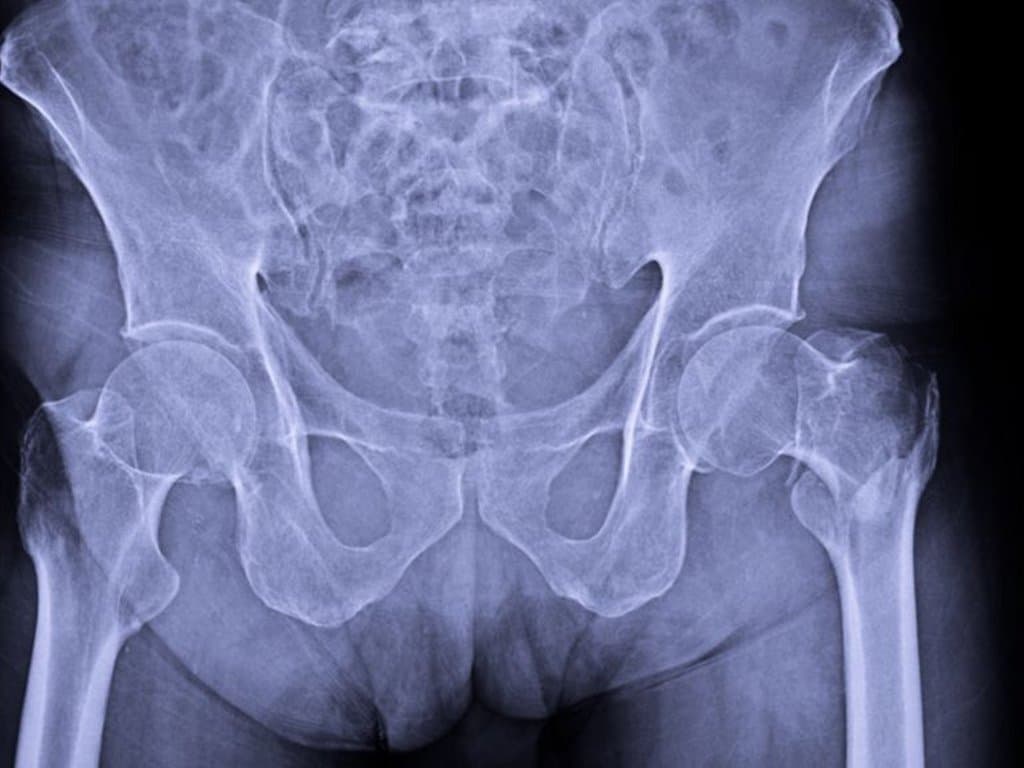 TyG index is linked to risk of fragility fractures in adults