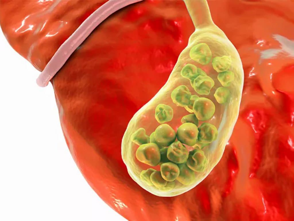 Cardiometabolic Index and Gallstone Risk: The Mediating Role of Diabetes