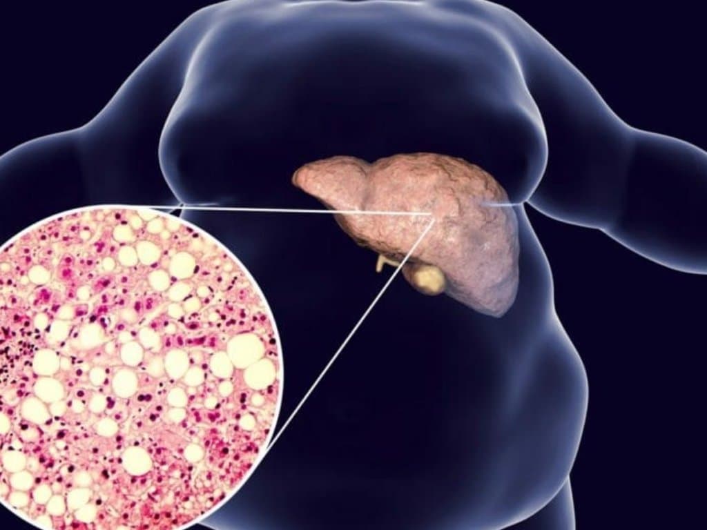 Prevalence of MAFLD and ALF in postoperative AOCP patients