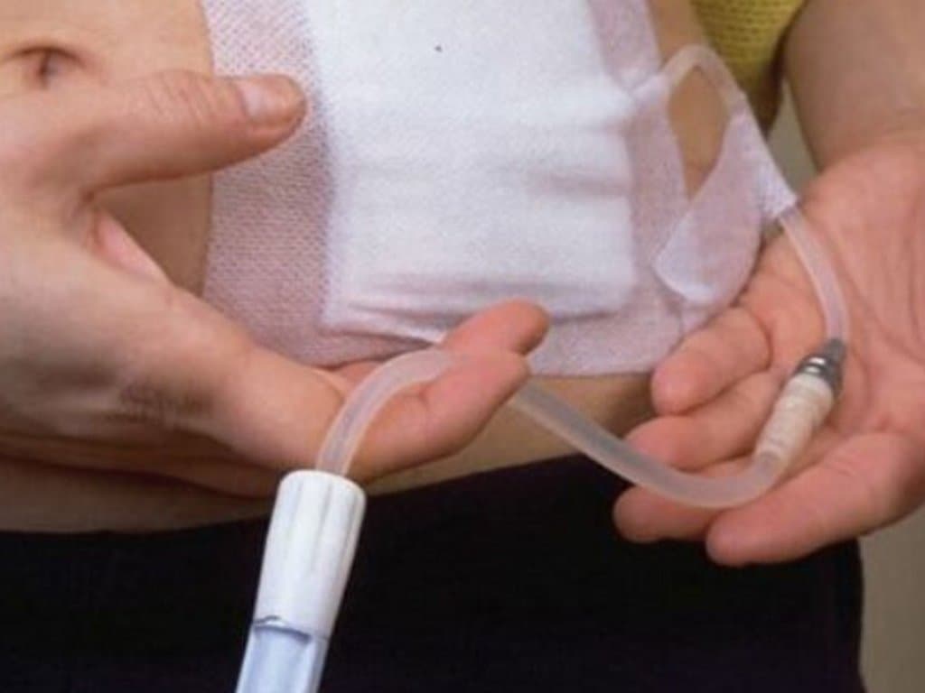 AIP and Mortality in Peritoneal Dialysis: Non-Linear Association
