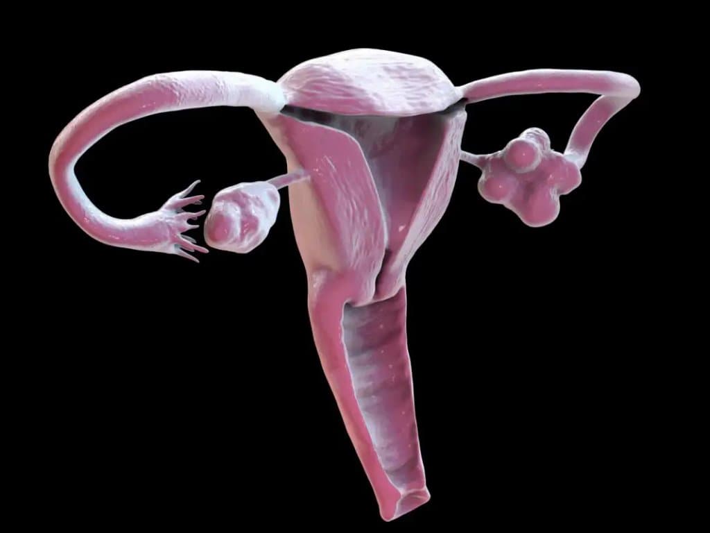 Blood type O is associated with heavier menstrual bleeding in PCOS patients