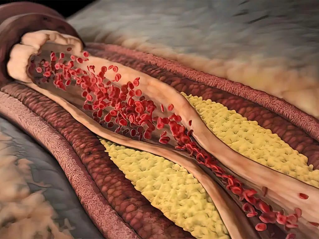 Association of MASLD severity with subclinical coronary atherosclerosis