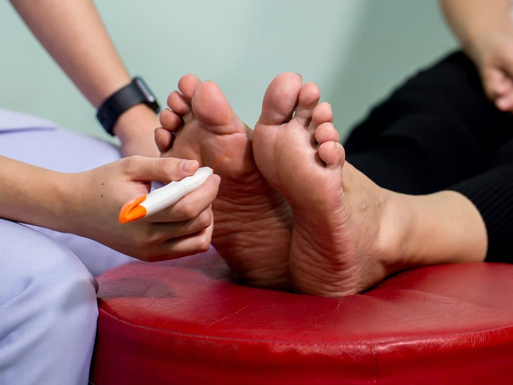 Cryotherapy's enhanced efficacy in upper extremities for CIPN prevention