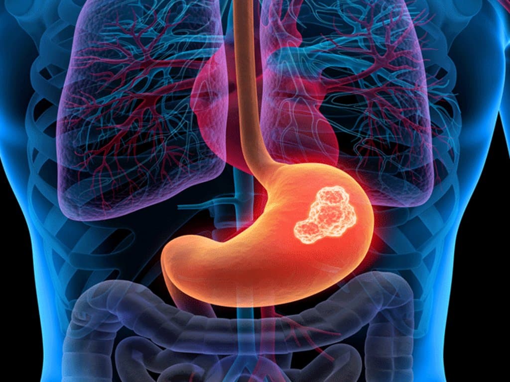 Adjuvant Chemotherapy in Elderly Gastric Cancer Patients: A Limited Benefit
