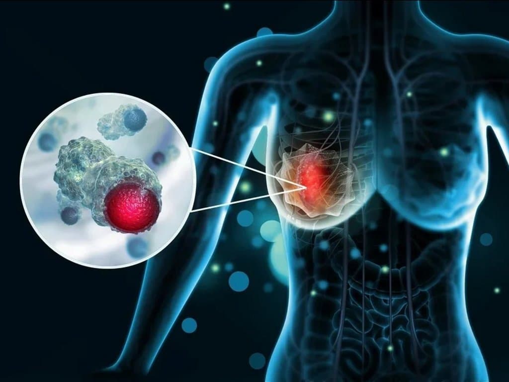 SGLT-2 Inhibitors and Breast Cancer: Incidence vs. Mortality