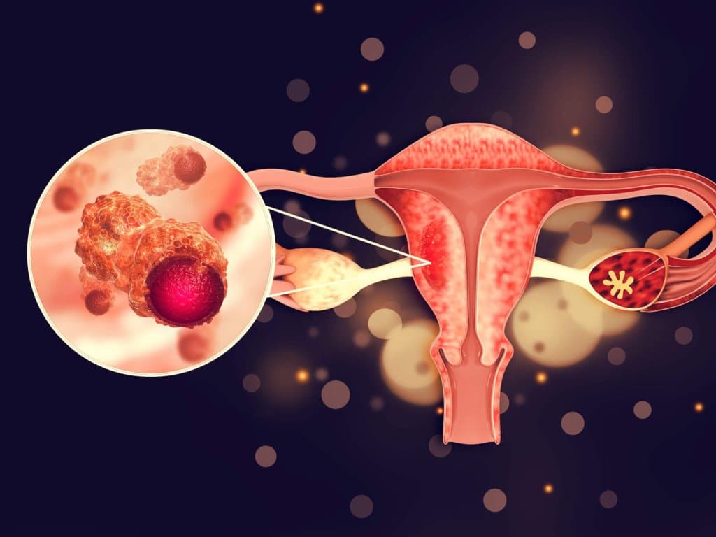 Predicting concurrent endometrial cancer in EIN patients