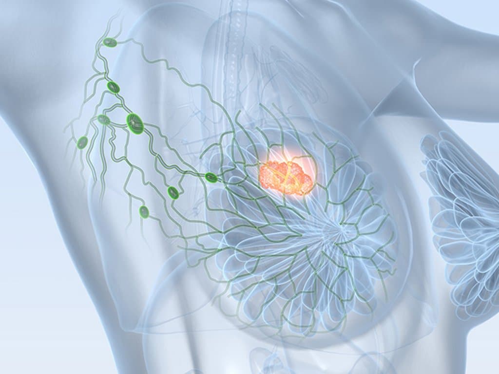 SNB alone sufficient for early breast cancer with one positive SLN