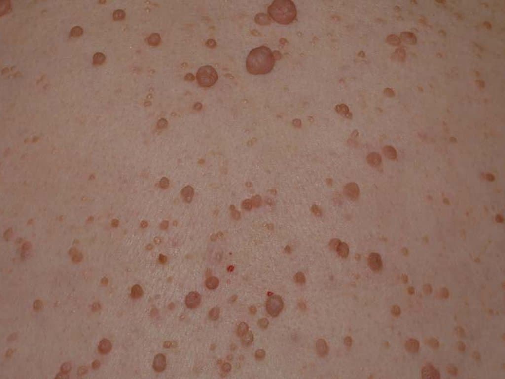Proteomic analysis reveals quiescent nature of cutaneous neurofibromas