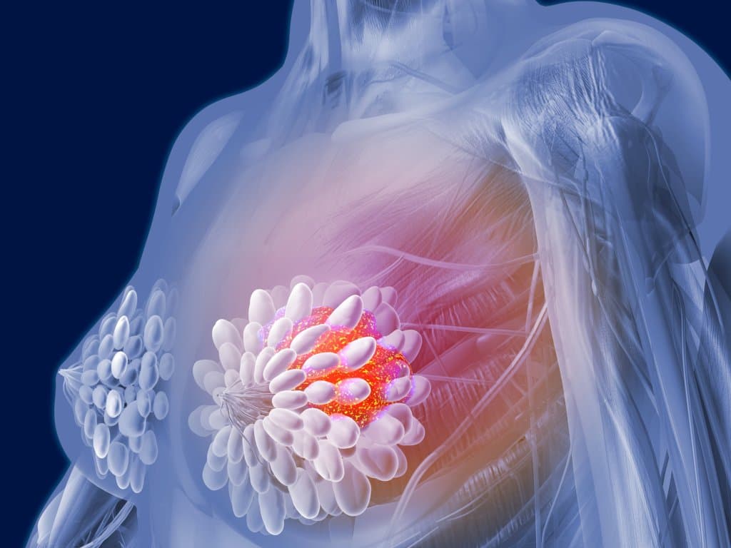 APTT/TT ratio as prognostic marker in nonmetastatic breast cancer