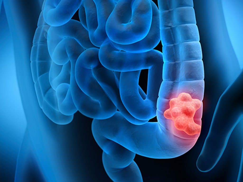 Multiple primary cancers in colorectal cancer survivors