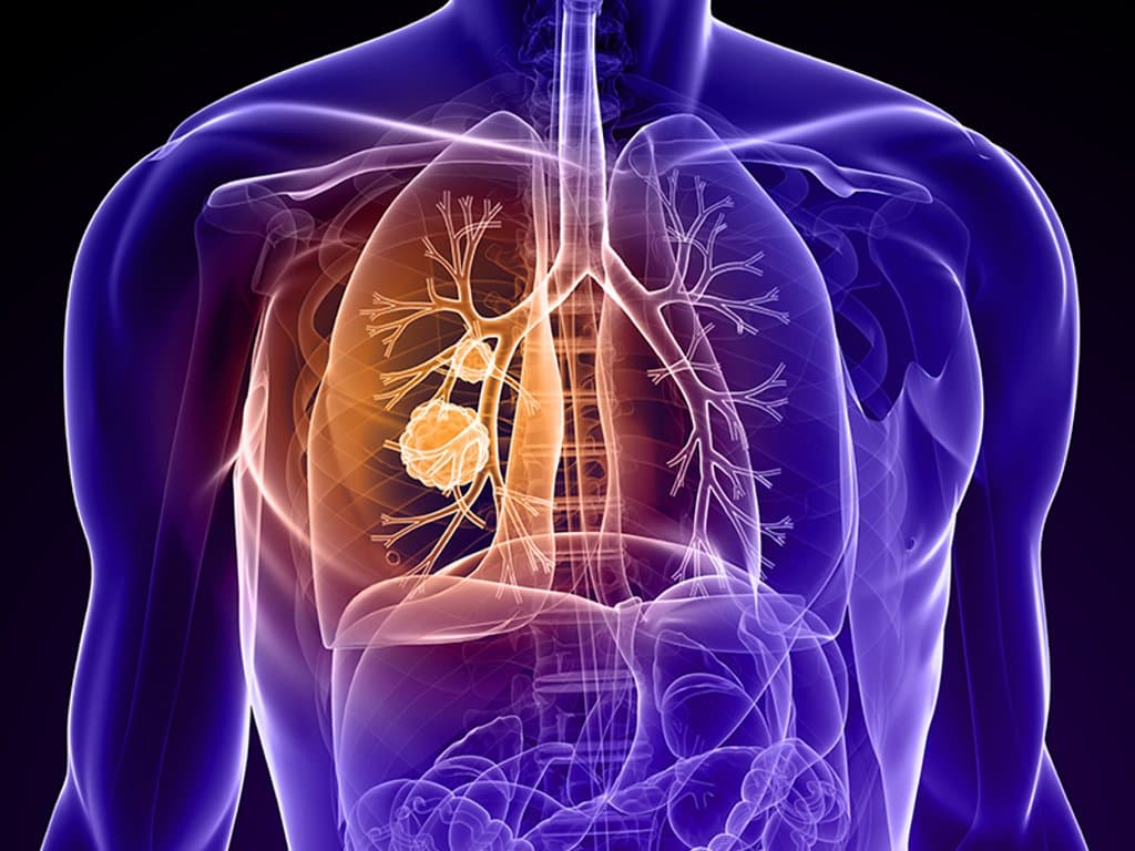 Mental health's impact on lung cancer screening and smoking behavior