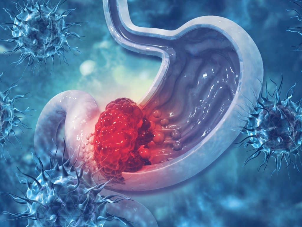 Postoperative HG and survival in non-diabetic gastric cancer patients