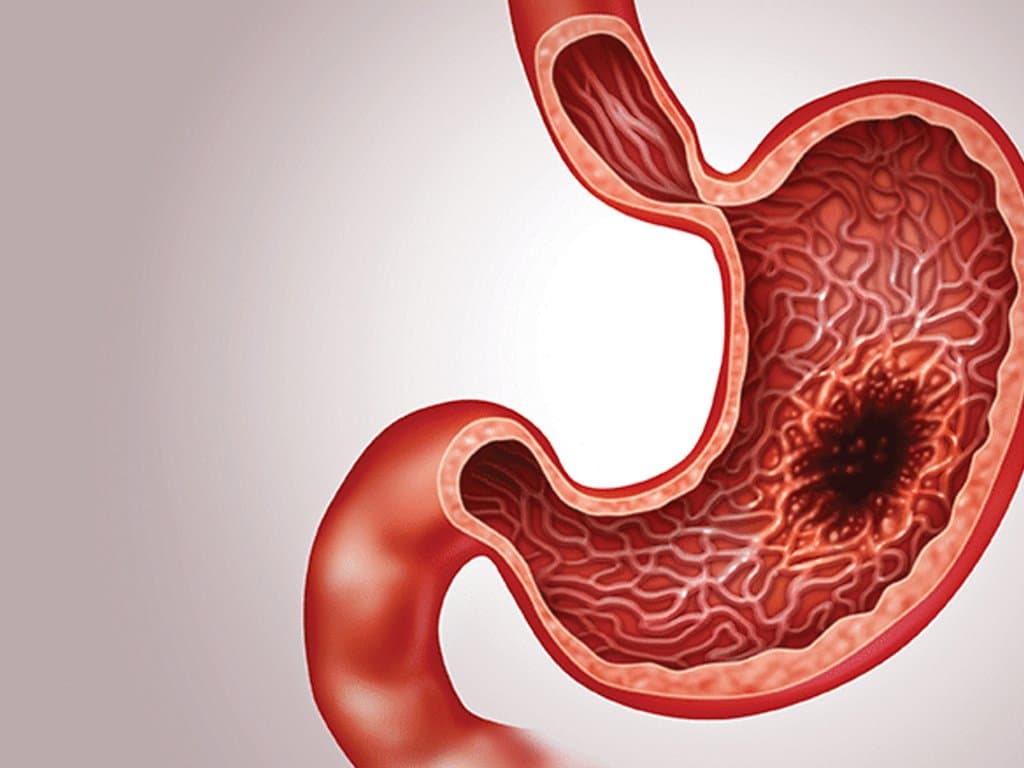 RG vs. LG for advanced gastric cancer post-neoadjuvant therapy