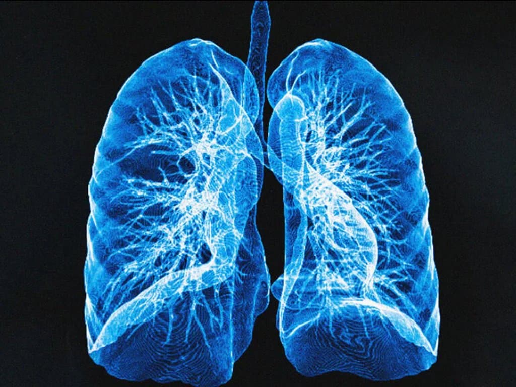 Early RT improves outcomes in ES-SCLC patients on chemo-immunotherapy