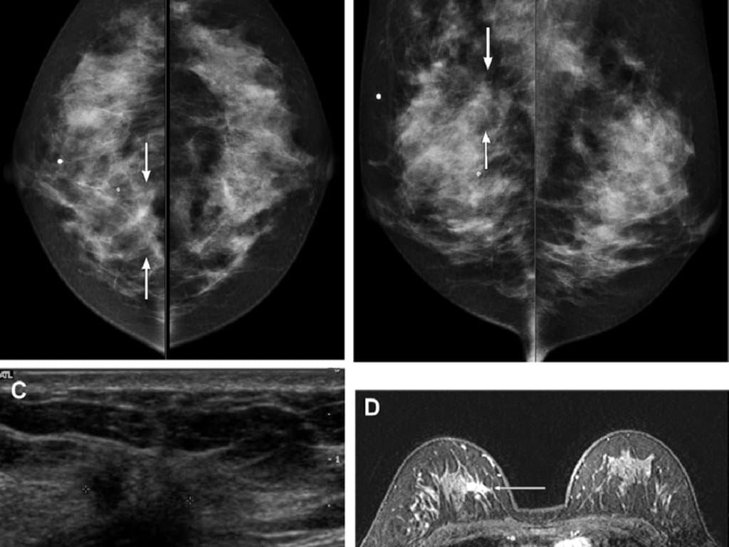 HER2-low Status in ILC: Clinicopathological Features and Survival