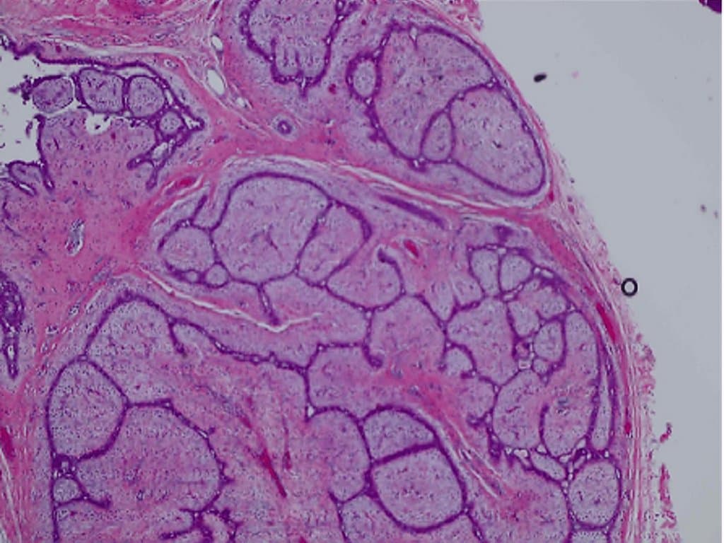 Risk factors for local recurrence in phyllodes tumors
