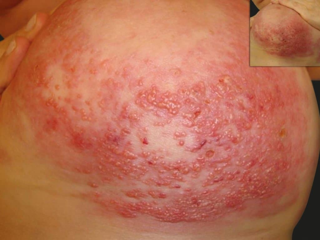 Clinical and molecular insights from inflammatory breast cancer patients