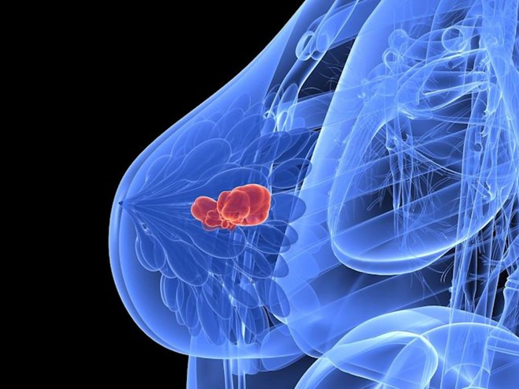 Treatment side effects and quality of life in breast cancer patients
