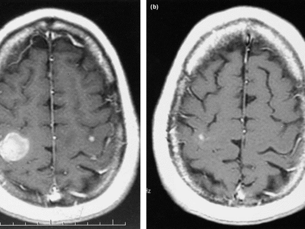 Impact of treatment and location on melanoma brain metastases survival