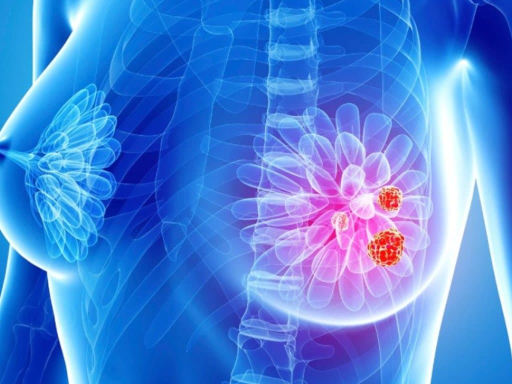 Low uptake of adjuvant bisphosphonates in early-stage breast cancer