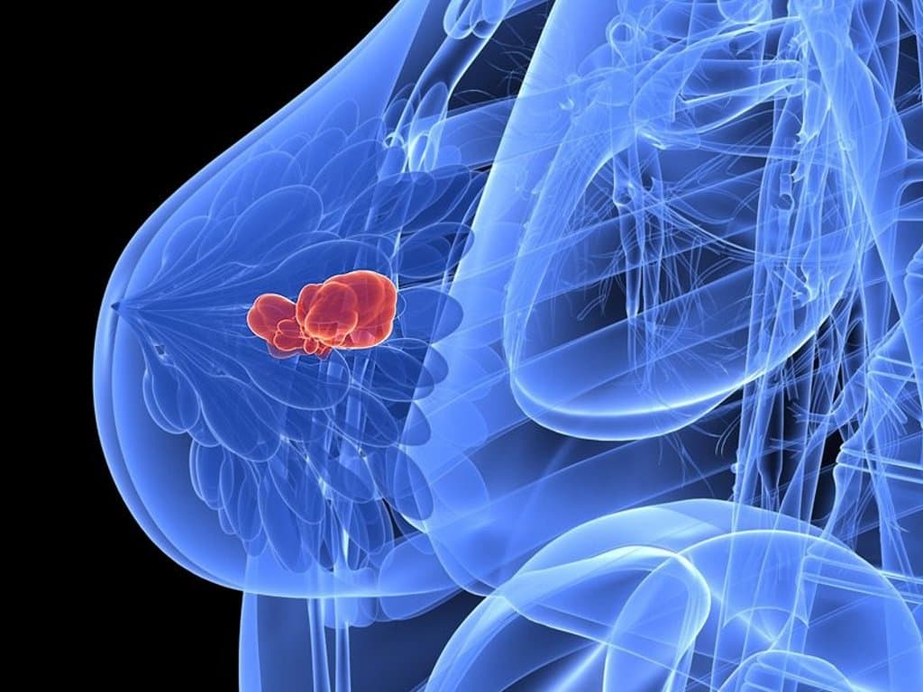 Sequential HER2-targeted TKIs in metastatic breast cancer