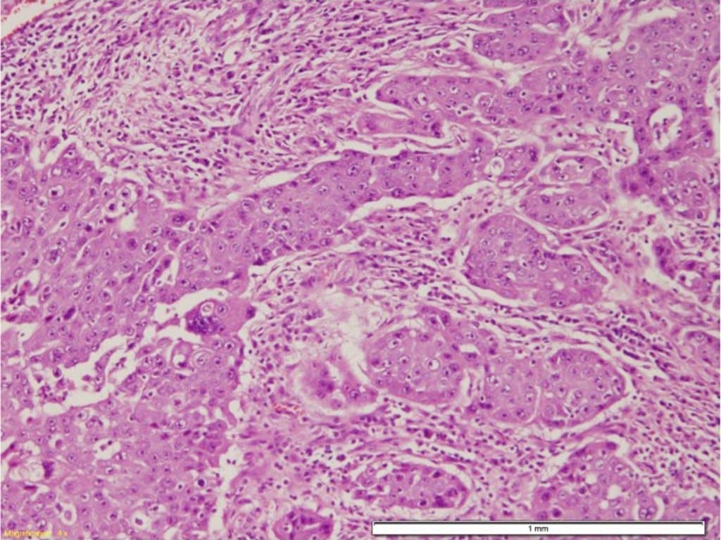 Immunotherapy enhances NAC response in metaplastic breast carcinoma