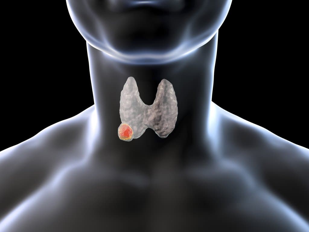Impact of surgical delay on T1bN1 papillary thyroid carcinoma outcomes