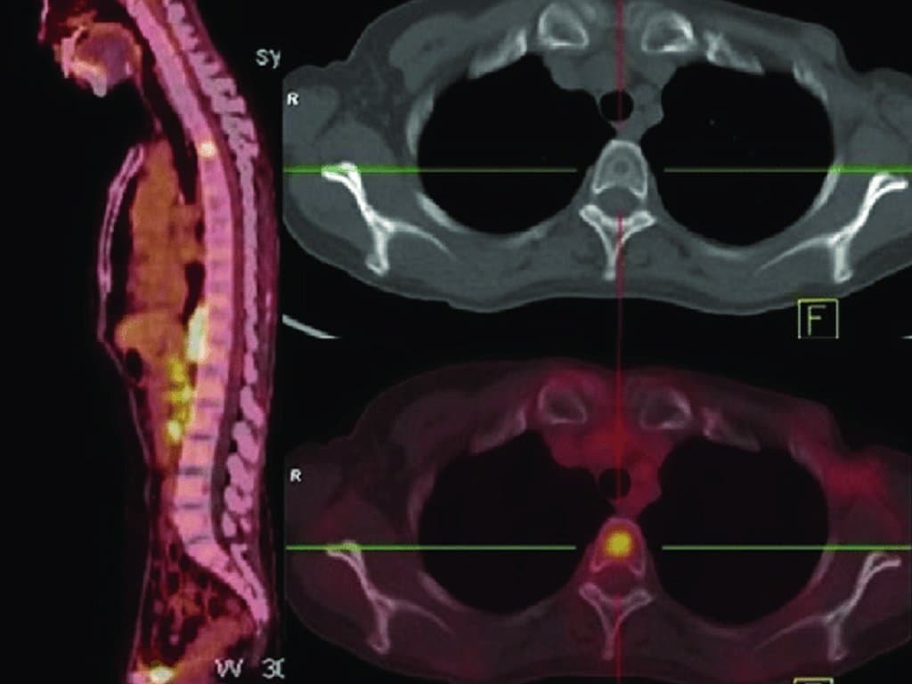 Circulating tumor DNA tumor fraction prognostic in bone-only MBC