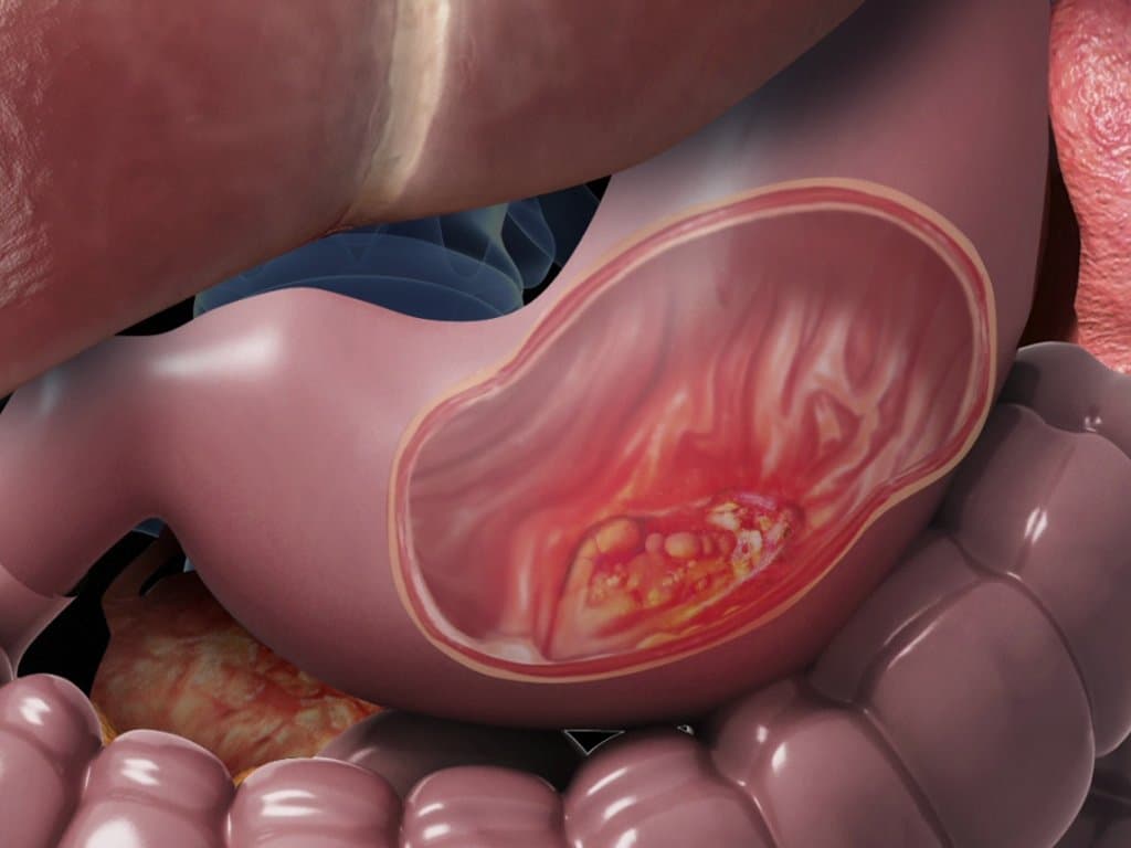 LAP and VAI predict immunotherapy outcomes in gastric cancer