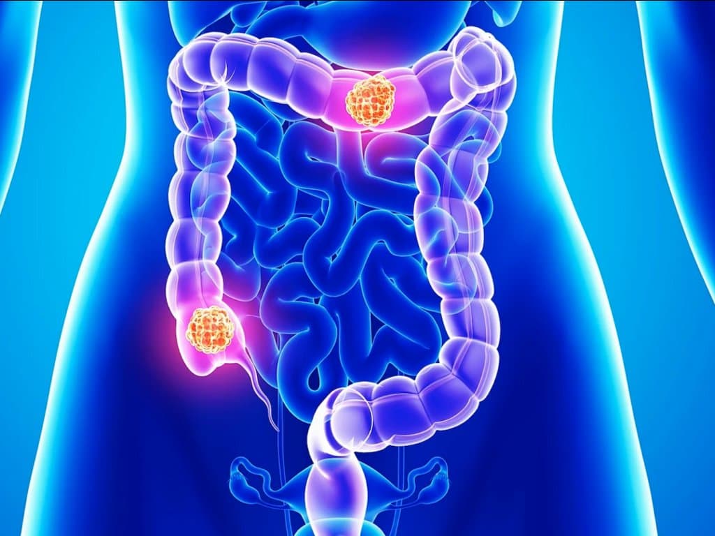 HRQoL predicts survival in non-metastatic colon cancer