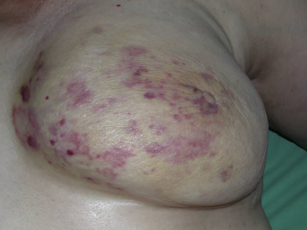 Biomarkers in Angiosarcoma: Diagnosis, Prognosis, and Therapy