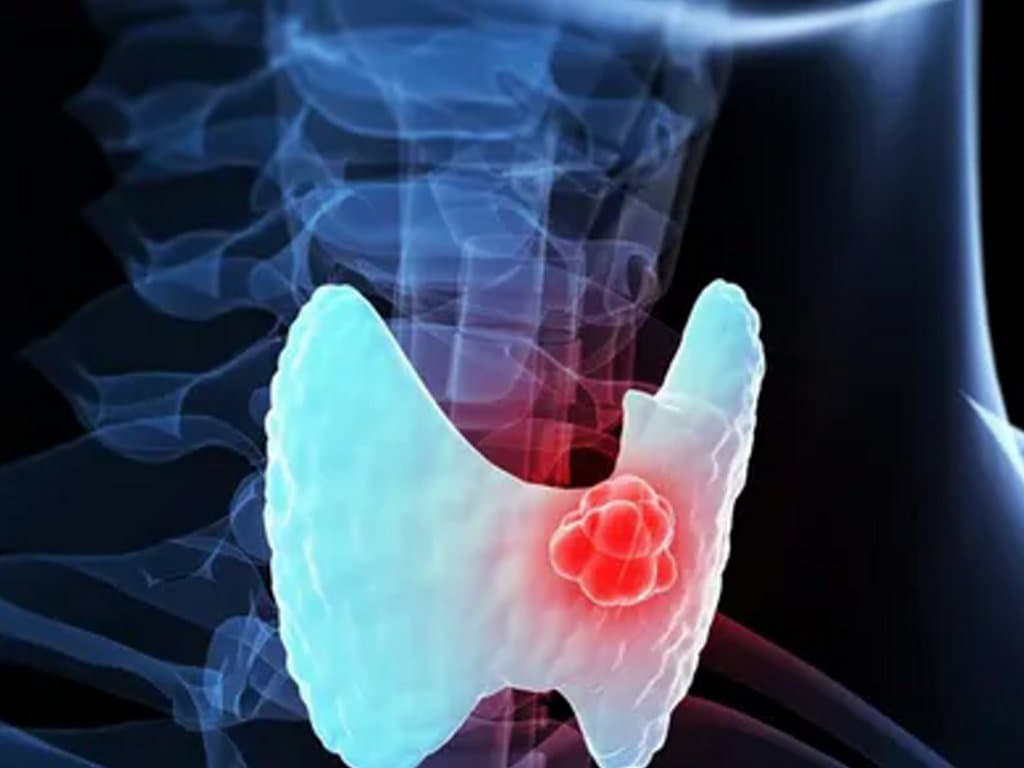 Age, sex, and progression risk in low-risk papillary thyroid carcinoma