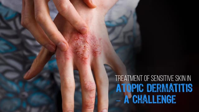 Treatment of Sensitive Skin in Atopic Dermatitis – A Challenge