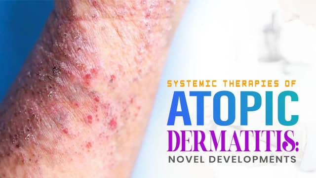 Systemic Therapies of Atopic Dermatitis: Novel Developments