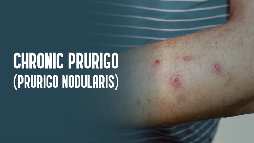 Chronic Prurigo (Prurigo Nodularis)