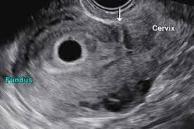 Modified curettage technique improves cesarean scar pregnancy outcomes