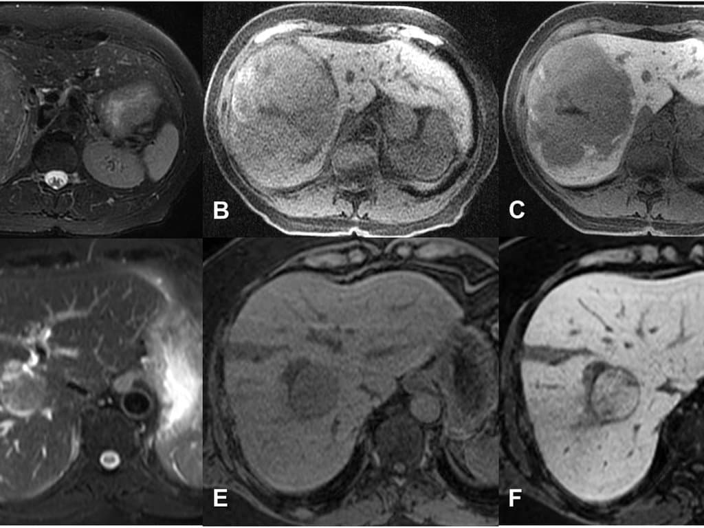 Surgery-TACE improves OS and prognosis in patients with HCC