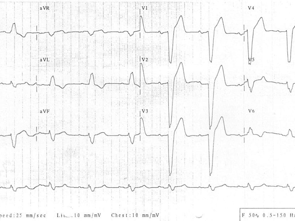 Conduction system pacing is effective in LBBB patients with low LVEF