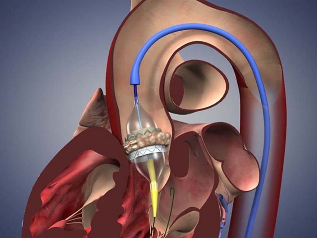 TAVR Outcomes in Patients With Active Cancer: Meta-Analysis