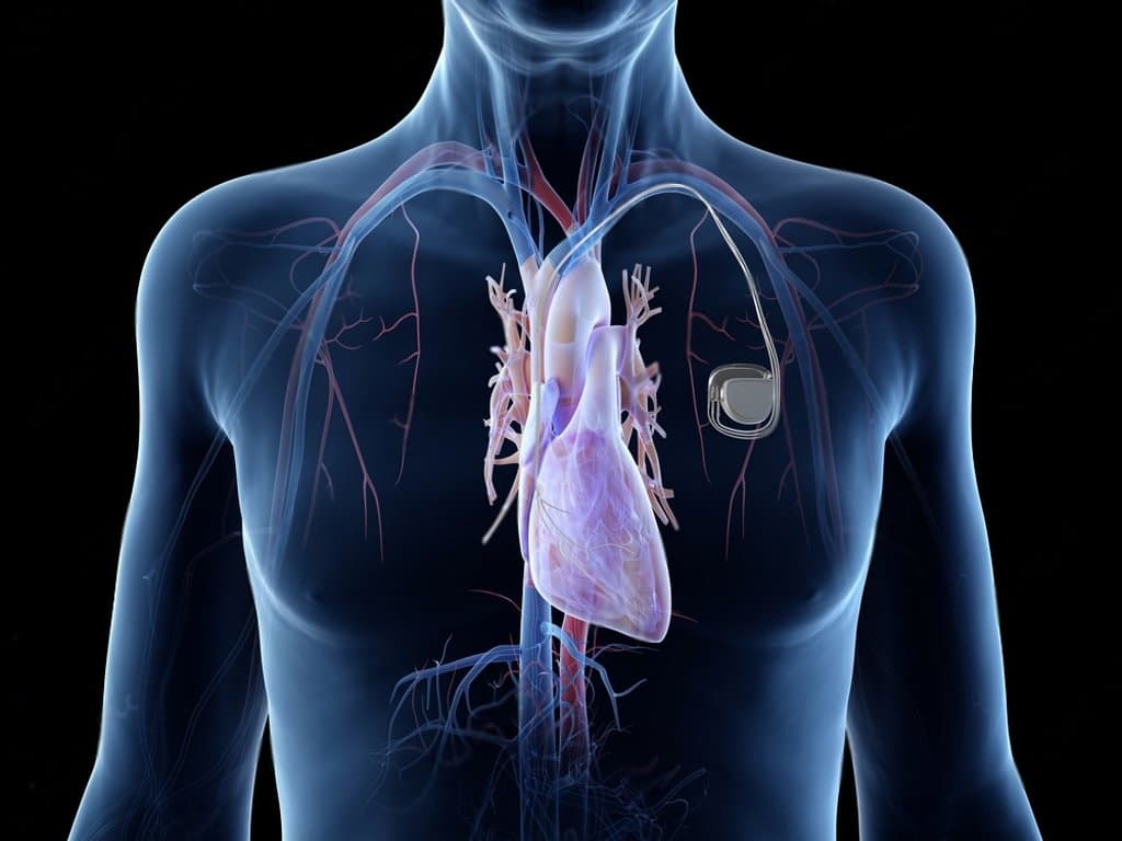 Prevalence of permanent pacemaker implantation after cardiac surgery