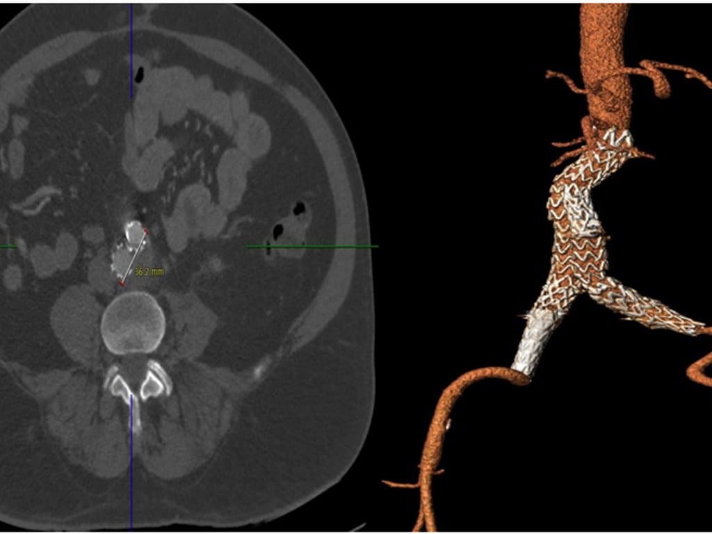 Impact of diabetes and metformin on aneurysm sac shrinkage post-EVAR