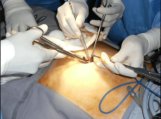 C-GALL challenges automatic surgery for every patient with uncomplicated symptomatic gallstones