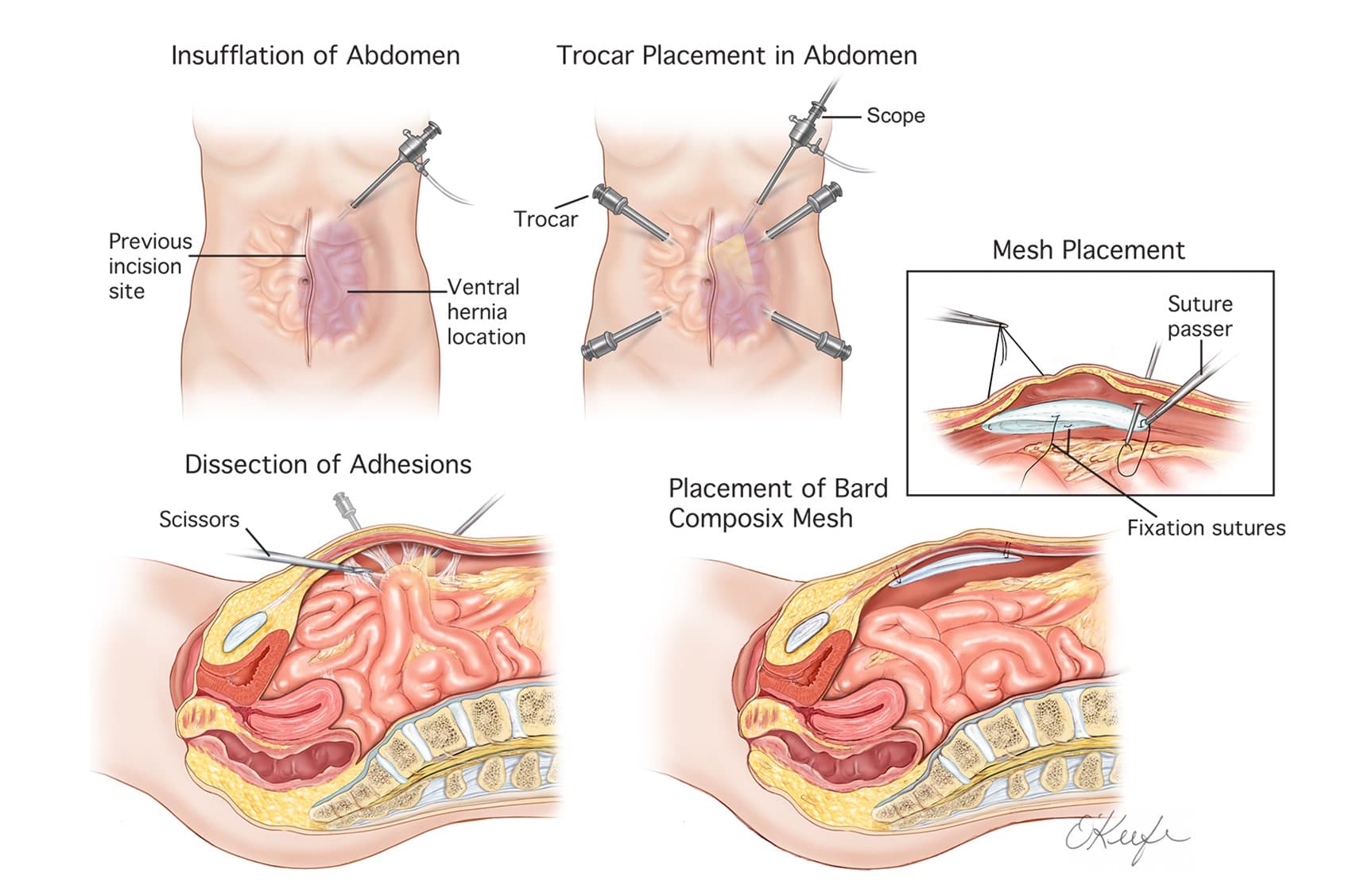TAPP and TEP both work for inguinal hernia—but their complication profiles are not identical