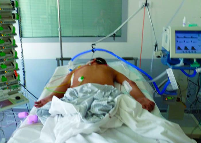 PROSEVA showed that prolonged prone positioning can save lives in severe ARDS