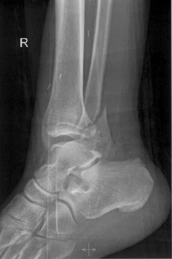 Suture Buttons Offer a Lower-Reoperation Path for Ankle Syndesmosis Fixation