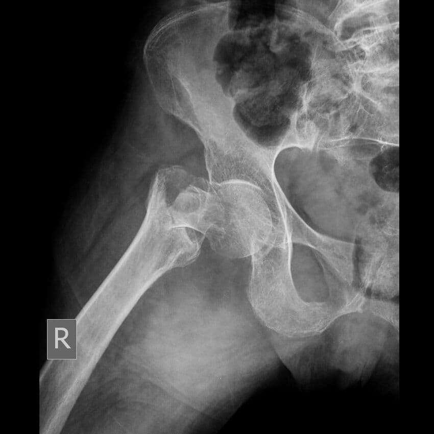 Pelvic Ring Injury Recovery Needs Patient-Centred Outcome Assessment, Not Just Radiographs