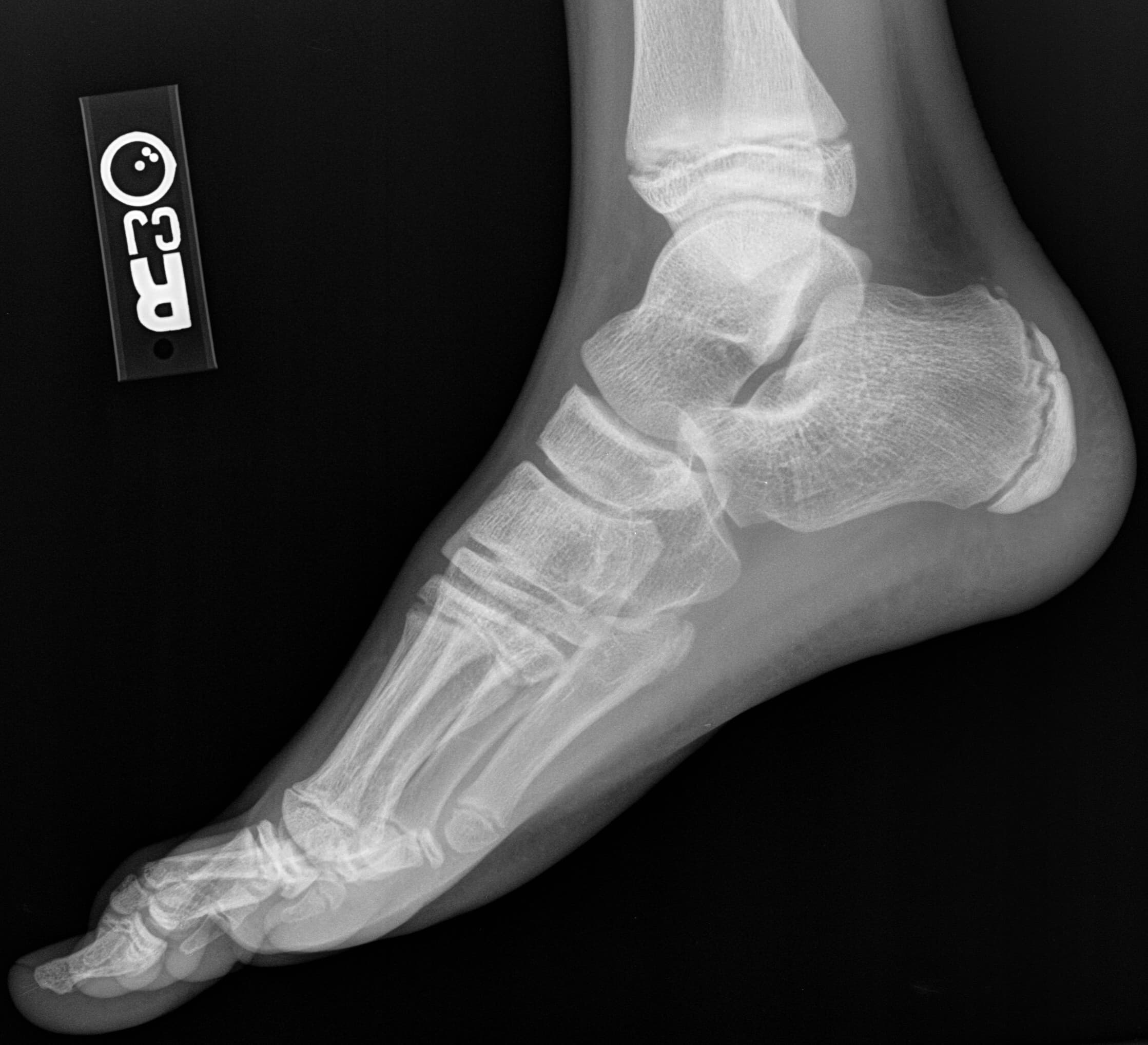 Long-Term Randomized Evidence Reinforces Ponseti Treatment for Clubfoot